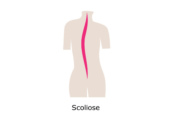 Scoliose in ruggenwervelkolom